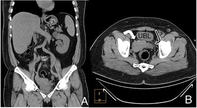 Case Report: Incidental finding of Zinner syndrome in an asymptomatic 53-year-old Palestinian male